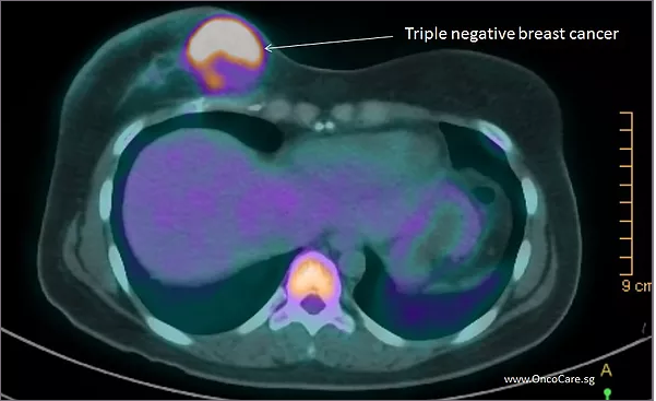 OncoCare-Singapore-Blog-Jan-March-2017-Ten-Facts-About-Triple-Negative-Breast-CancerTNBC