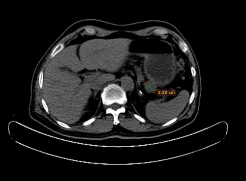 OncoCare-Singapore-Blog-Jan-March-2017-What-are-GISTs