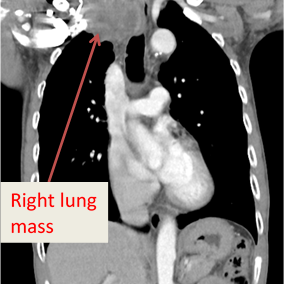 OncoCareSingapore-Blog-Non-Small-Cell-Lung-CancerNSCLC-284x284